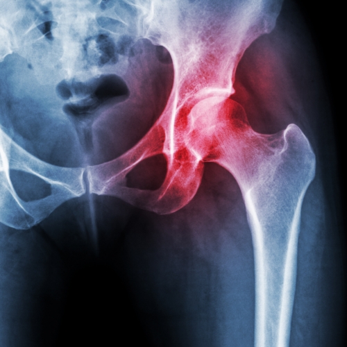 Hip Pain - Omni Physical Therapy & Wellness